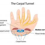 carpal tunnel syndrome surgery