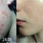 tretinoin