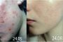 tretinoin