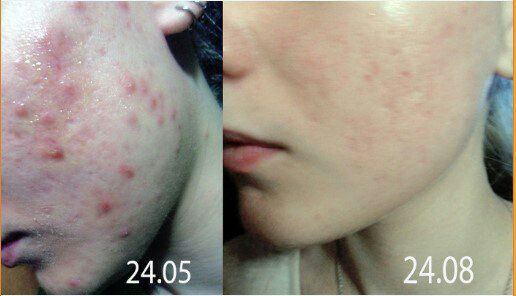 tretinoin