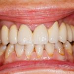 Periodontal Disease Treatment