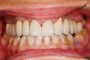 Periodontal Disease Treatment