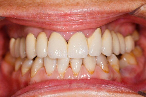 Periodontal Disease Treatment