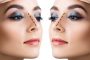 Rhinoplasty-Guide