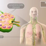 Non-Hodgkin Lymphoma Treatments