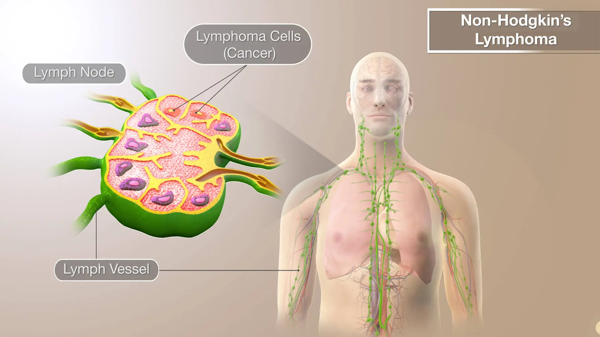 Non-Hodgkin Lymphoma Treatments