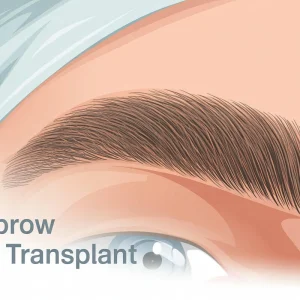 Eyebrow Hair Transplant Eyebrow Hair Transplant