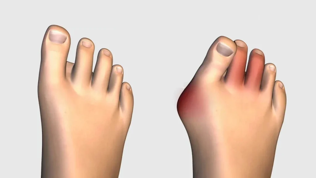 Lapiplasty Bunion Surgery Lapiplasty Bunion Surgery
