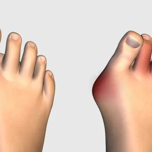 Lapiplasty Bunion Surgery Lapiplasty Bunion Surgery