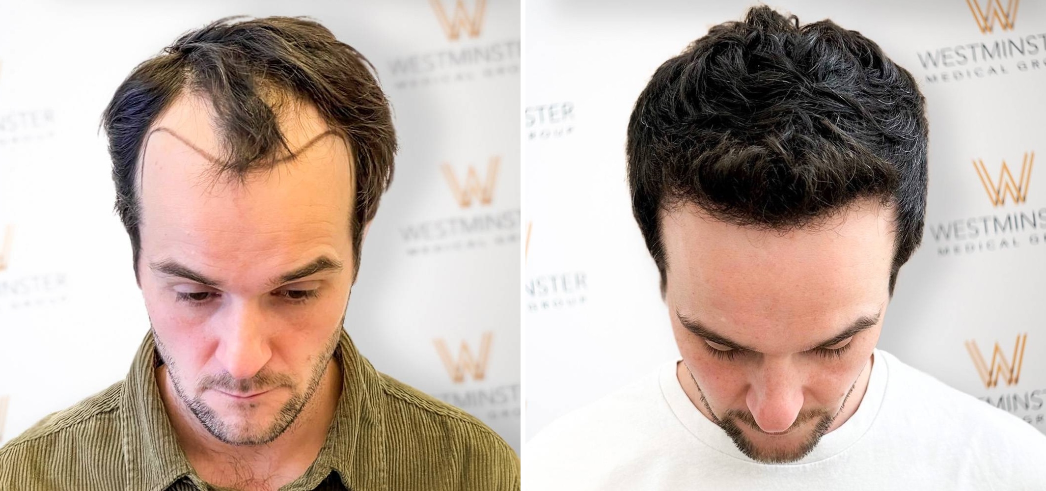 What Are the Most Effective Hair Transplant Techniques at Westminster Medical Group? Hair Transplant London